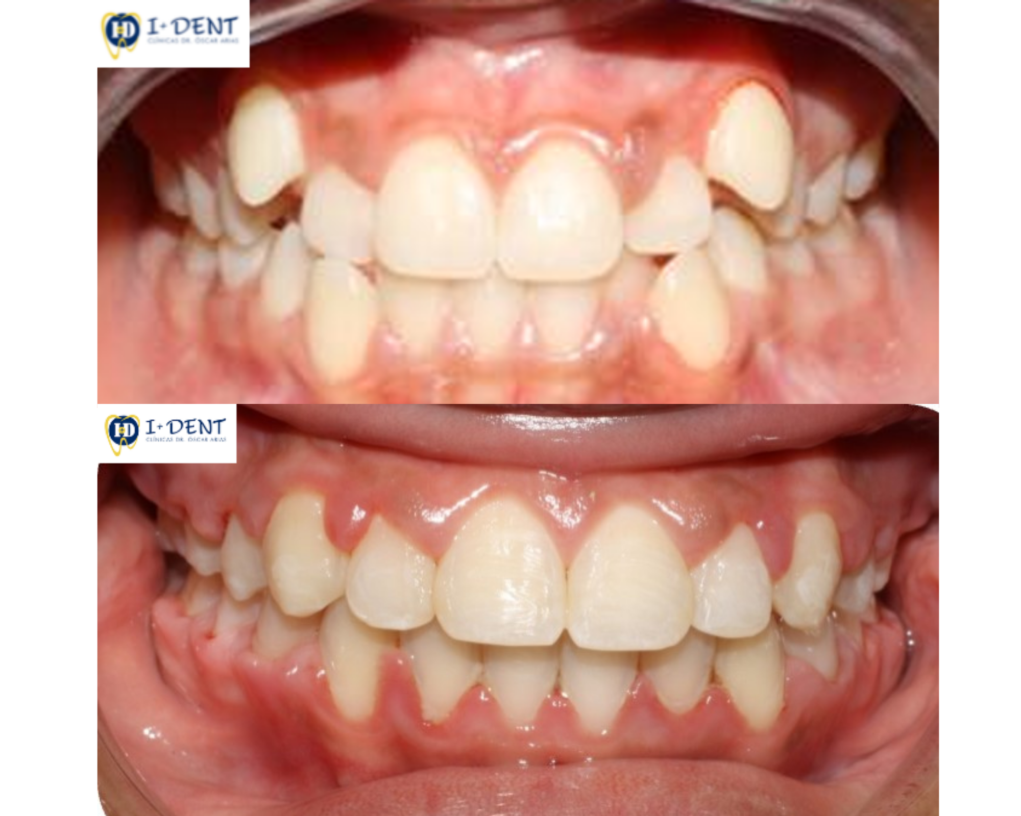 Caso de ortodoncia con Brackets 18 meses